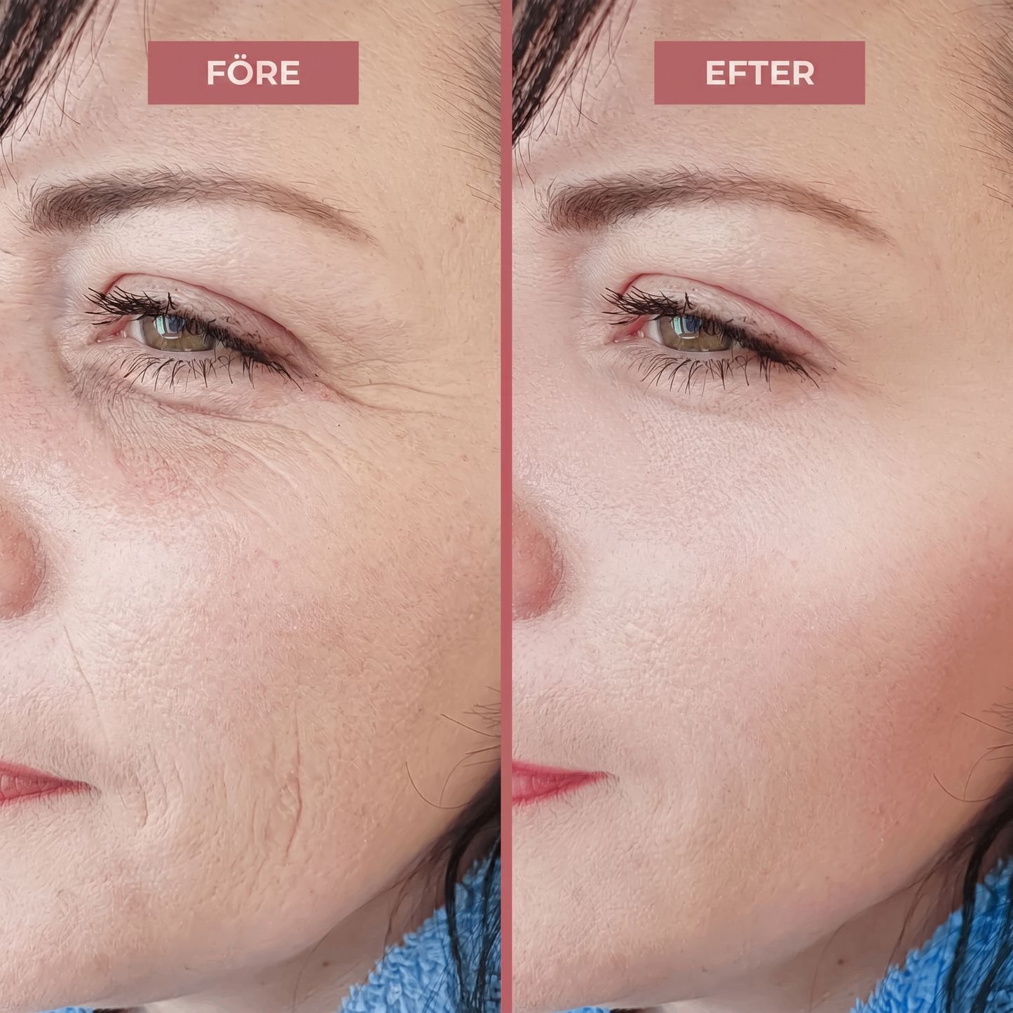 Optimized Volufiline Serum